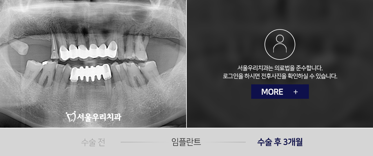 임플란트-전후사진2